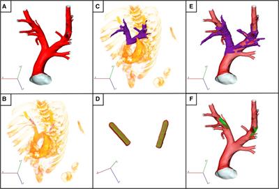 In-silico enhanced animal study of pulmonary artery pressure sensors: assessing hemodynamics using computational fluid dynamics